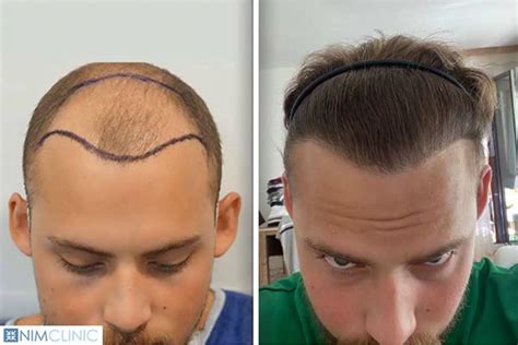 hair transplant albuquerque|TOP 10 BEST Hair Replacement in Albuquerque, NM .